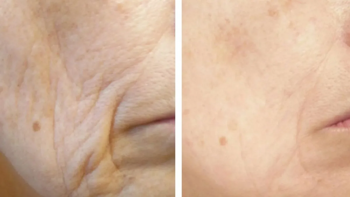 80-year-old credits surgeon-approved collagen for 'no wrinkles'