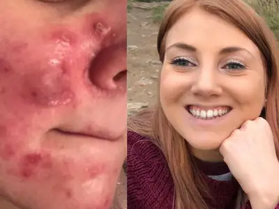 £16 Acne Serum Praised as 'Amazing' by Shoppers in Weeks