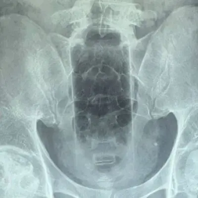 Doctors remove 20cm bottle from man's rectum after cleaning mishap