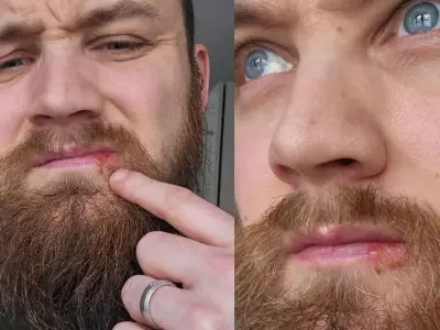 Man Claims £9 Balm Kept Cold Sores Away for Four Years