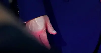 Trump's Discolored Hand Sparks Health Concerns at UFC Event