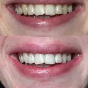 70p Teeth Whitening Strips Deliver Results in 10 Days, Say Users