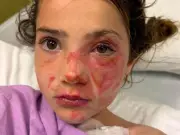 Children Suffer Severe Burns from 'Squishy' Toy Microwave Trend Requiring Surgery