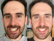 Coffee drinker's 'lifetime of stains' gone with £10 teeth whitener