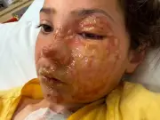 Doctor's Urgent Warning After Girl, 10, Burned by Viral Toy Trend