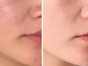 Dr Sam Bunting Launches £36 Moisturiser for Oily, Blemish-Prone Skin