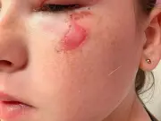 Five Terrifying Online Trends: Scottish Kids Burned by Squishy Toys
