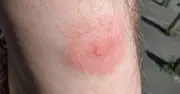 GP Warns of Lyme Disease Surge in UK Summer: Full Symptom List
