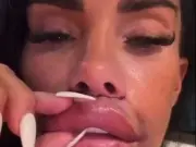 Katie Price Shares Graphic Lip Lift Injuries, Plans Nose Job