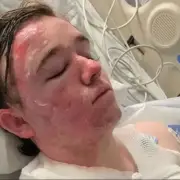 McDonald's Employee Severely Burned After Colleague Throws Hot Oil on Him