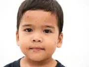 Measles Symptoms Warning to Parents as Cases Rise and Two Children Die in 2026