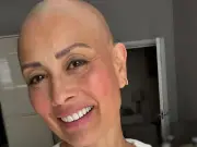 Melanie Sykes Reveals Bald Head in Brave Alopecia Update