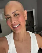 Melanie Sykes Shows Bald Head Amid Alopecia Battle