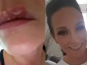 Mum Says Daughter 'Hasn't Had a Single Cold Sore' Since Using £9 'Miracle' Balm