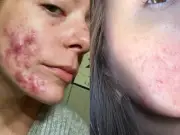 Teen's Acne Cured by £16 Clarol Silver Serum After Failed Treatments