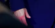 Trump's Discolored Hand Sparks Health Concerns at UFC Event