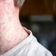 UK Health Chiefs Urge Vaccination After Two Child Measles Deaths