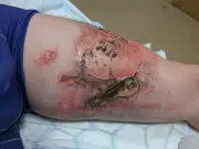 Vape Battery Explodes in Pocket, Melts Skin Off Man's Leg
