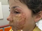 Viral Squishy Toy Warning: Children Hospitalised with Severe Burns