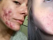 Woman Says £16 Serum Cleared Acne and Restored Confidence in Two Weeks