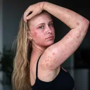 Woman's Skin Feels Like Acid After Steroid Creams for Eczema
