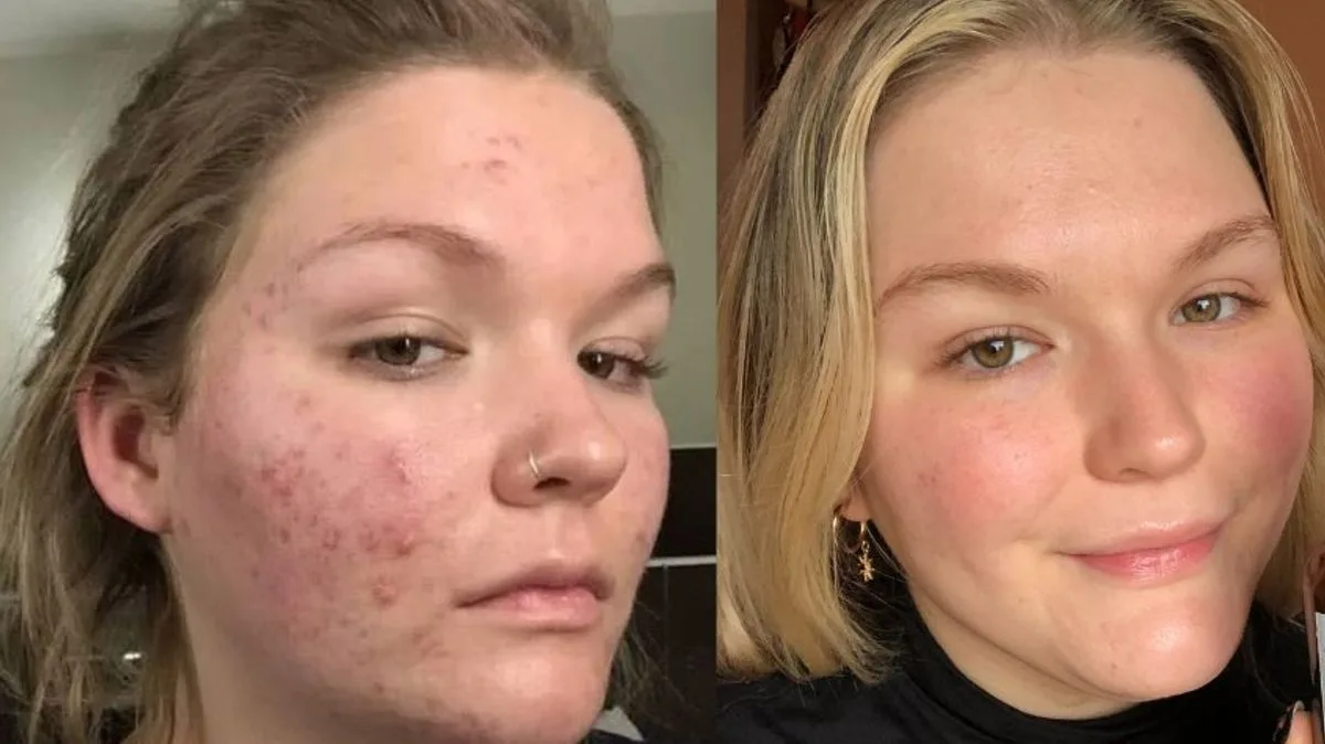 'Life-Changing' £10 Anti-Acne Serum with 2,400 Reviews 'Gives Confidence Back'