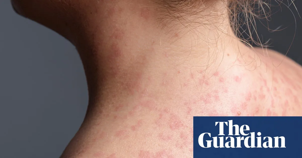 Measles Cases Triple in Australia as Vaccination Rates Fall Below Herd Immunity Threshold