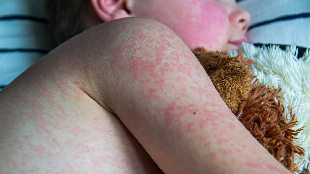 Unvaccinated children could be sent home amid measles outbreak, London health leaders warn