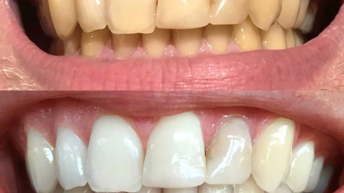 SmilePro LED Teeth Whitening Kit Now £44 in Flash Sale