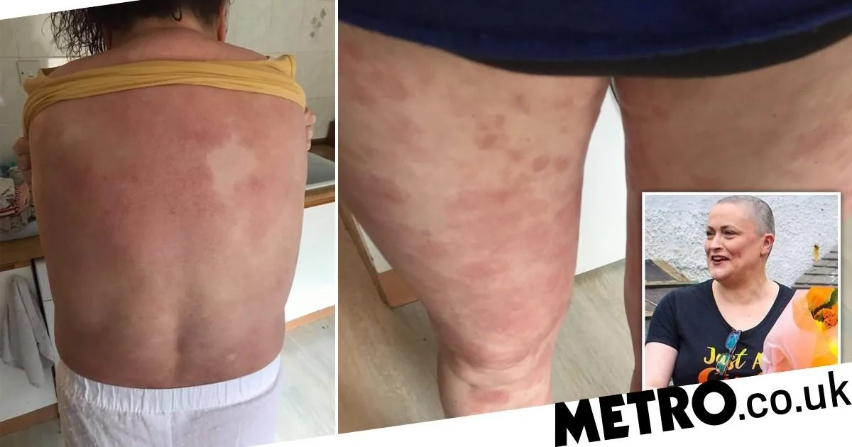 Woman's Stress Rash Was Actually Rare Blood Cancer She Had for 20 Years