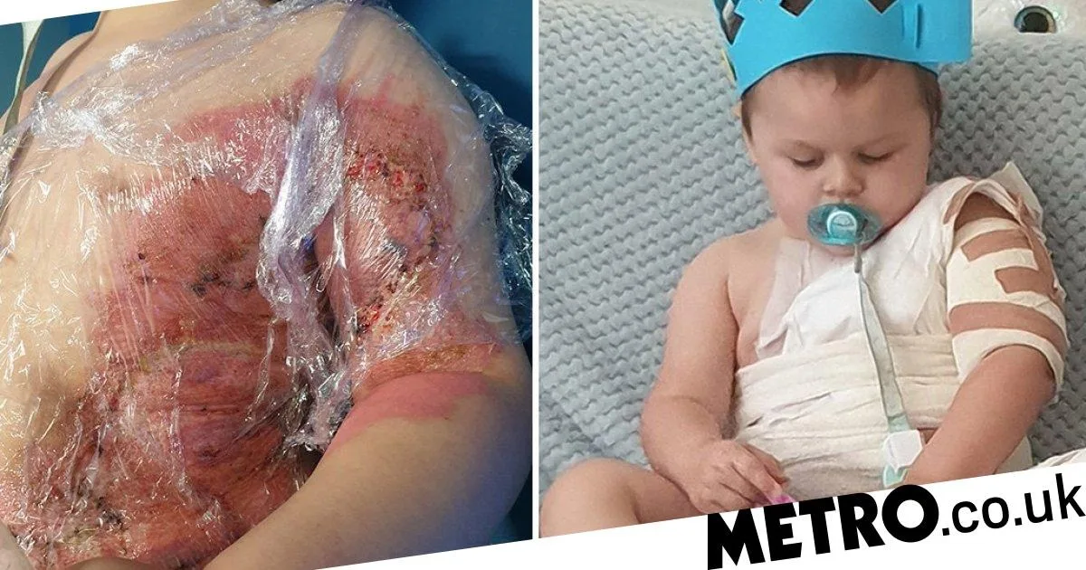 Toddler Severely Burned by Spilled Coffee Prompts Safety Warning