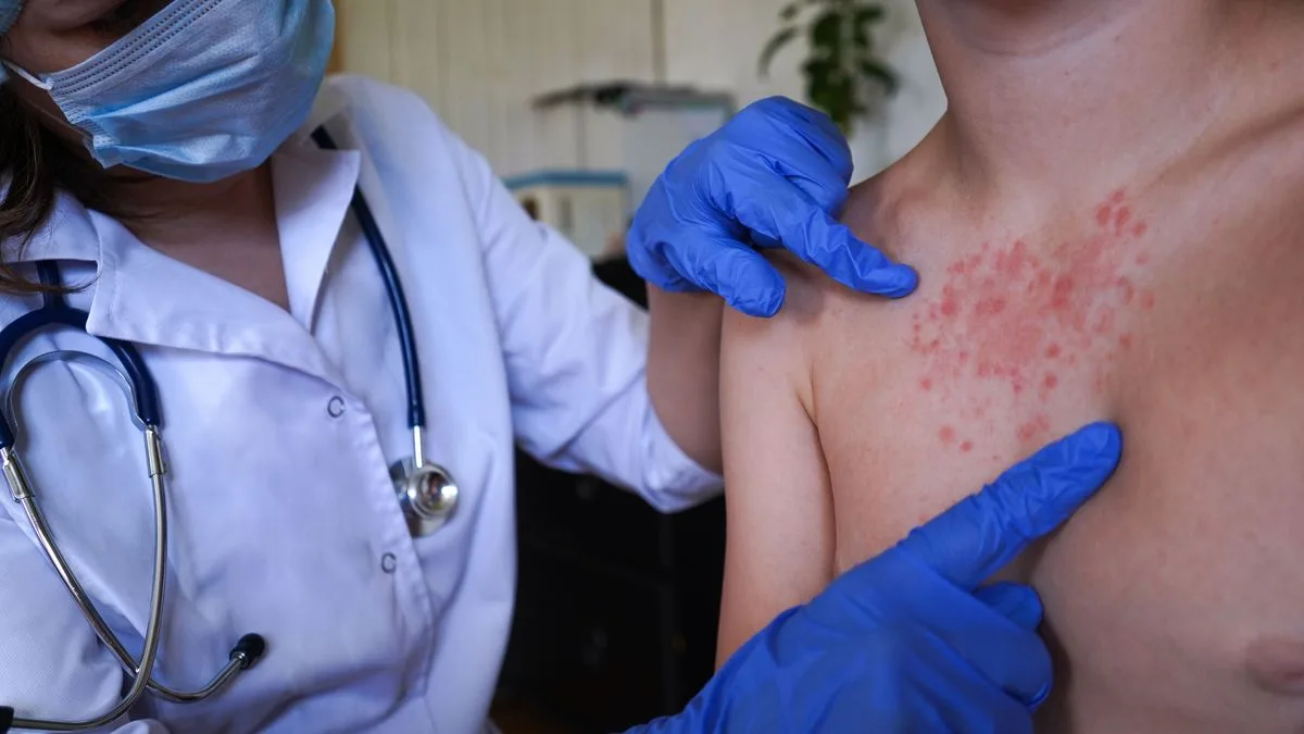 Measles Hotspots Mapped in UK Amid Low Vaccination Rates