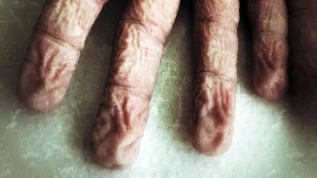 Wrinkled Fingers in Water Could Signal Underlying Health Issues