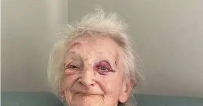 Daughter's horror after finding mum covered in bruises at UK care home