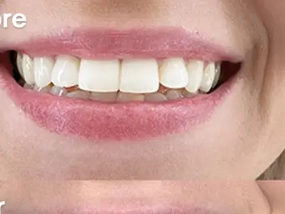 Tea Drinker, 60, Gets Whiter Teeth with £25 MySweetSmile Powder