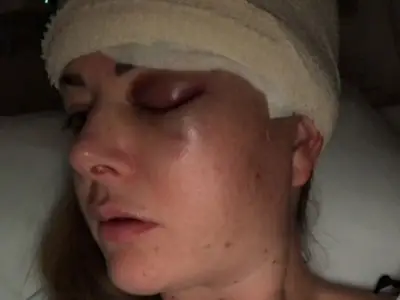 Women Demand Depo-Provera Warning Update After Brain Tumors