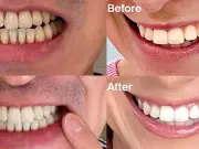 32p-a-Use Whitening Powder Eliminates Stains in 3 Uses, Say Fans