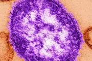Adult Dies of Measles in London as Cases Continue to Rise Across England