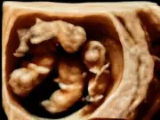 Australian Mum Gives Birth to 'Unheard of' Identical Quadruplets