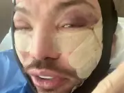 Bobby Norris doesn't rule out more surgery after facelift at 39