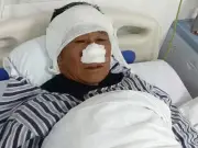 Brave man who lost nose saving woman from strangler says it was worth it