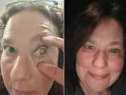 Contact lens infection forces woman to have eye removed