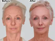 Debbie McGee Looks 20 Years Younger After Non-Surgical Facelift