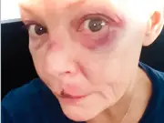 Gail Porter Reveals Injuries After Tube Station Fall, Urges Kindness