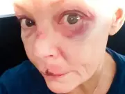 Gail Porter shows bruising and scars after Tube station fall