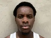Man with rare skin condition reaches millions on TikTok to raise awareness