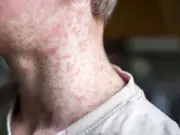 Measles Death Confirmed in UK as Cases Surge and Vaccine Drive Launched