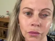 Mum's eye eaten by parasites after washing face with contact lenses