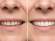 MySweetSmile Teeth Whitening Powder Sale: 30% Off for July Payday