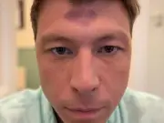 Patrick Christys Reveals Heart-Shaped Bruise from Parenting Mishap